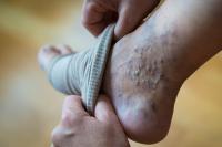 close-up of a person's foot with varicose veins